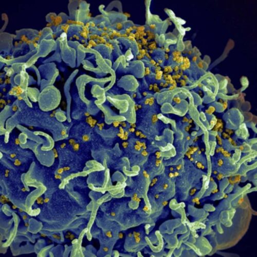 First case of HIV cure in a woman after stem cell transplantation